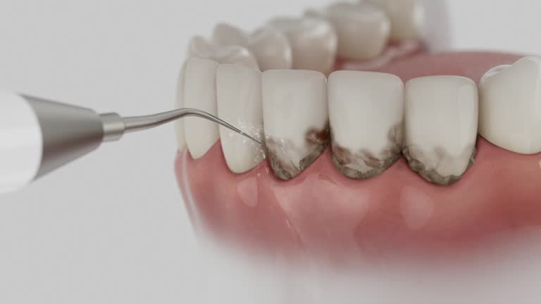 Trusted Dental Veneers service in Broken Arrow, OK - Dentist Open Now